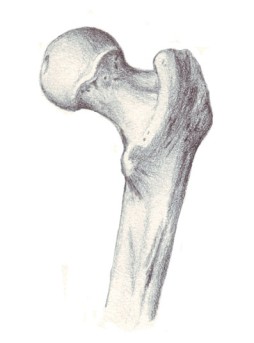 Hip Osteotomy by OrangeCountySurgeons